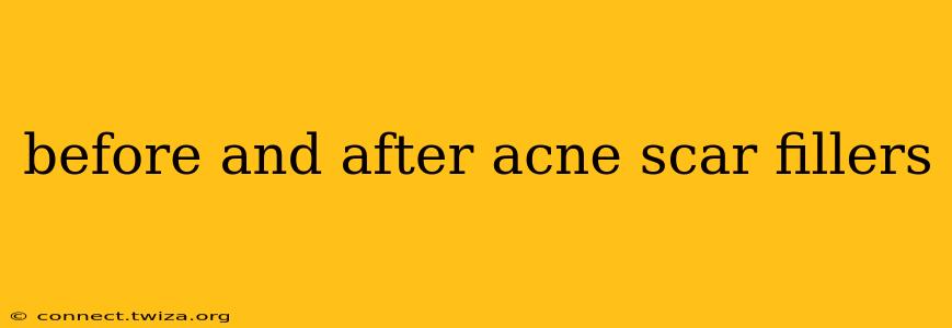 before and after acne scar fillers