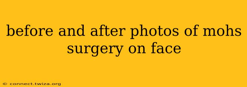 before and after photos of mohs surgery on face