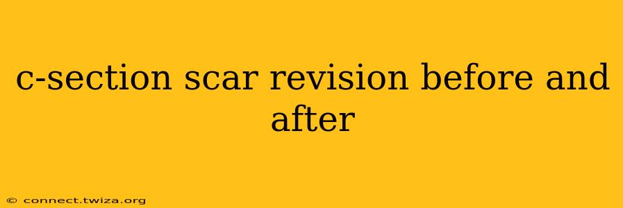 c-section scar revision before and after