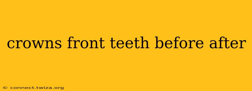 crowns front teeth before after
