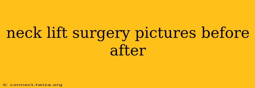 neck lift surgery pictures before after