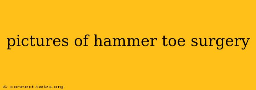 pictures of hammer toe surgery