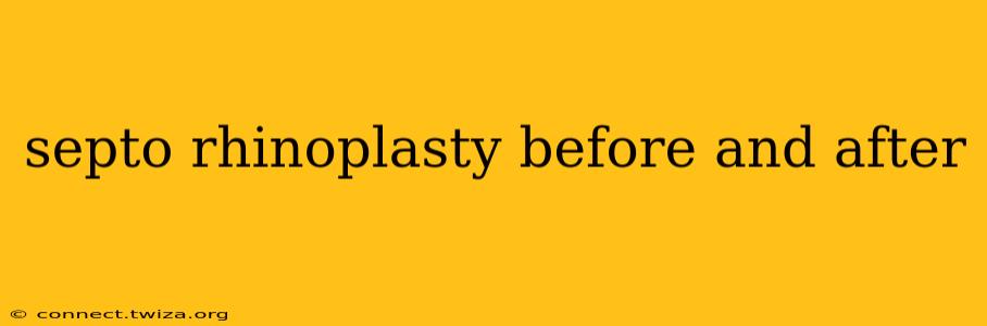 septo rhinoplasty before and after